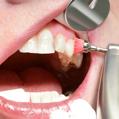 parodontologie-dentilus-behandlungsspektrum