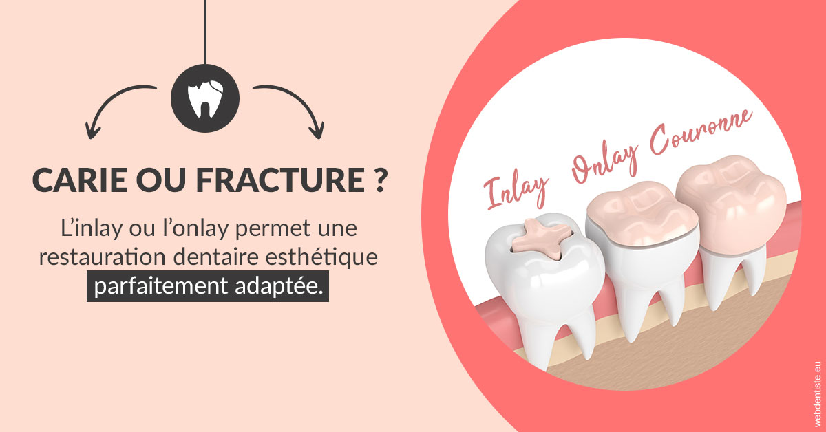 https://cabinetdentairemast.ch/T2 2023 - Carie ou fracture 2