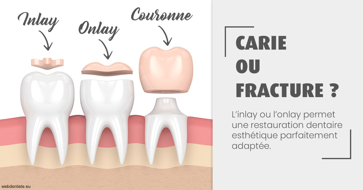 https://cabinetdentairemast.ch/T2 2023 - Carie ou fracture 1