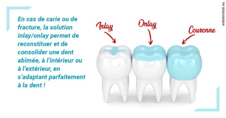 https://cabinetdentairemast.ch/L'INLAY ou l'ONLAY